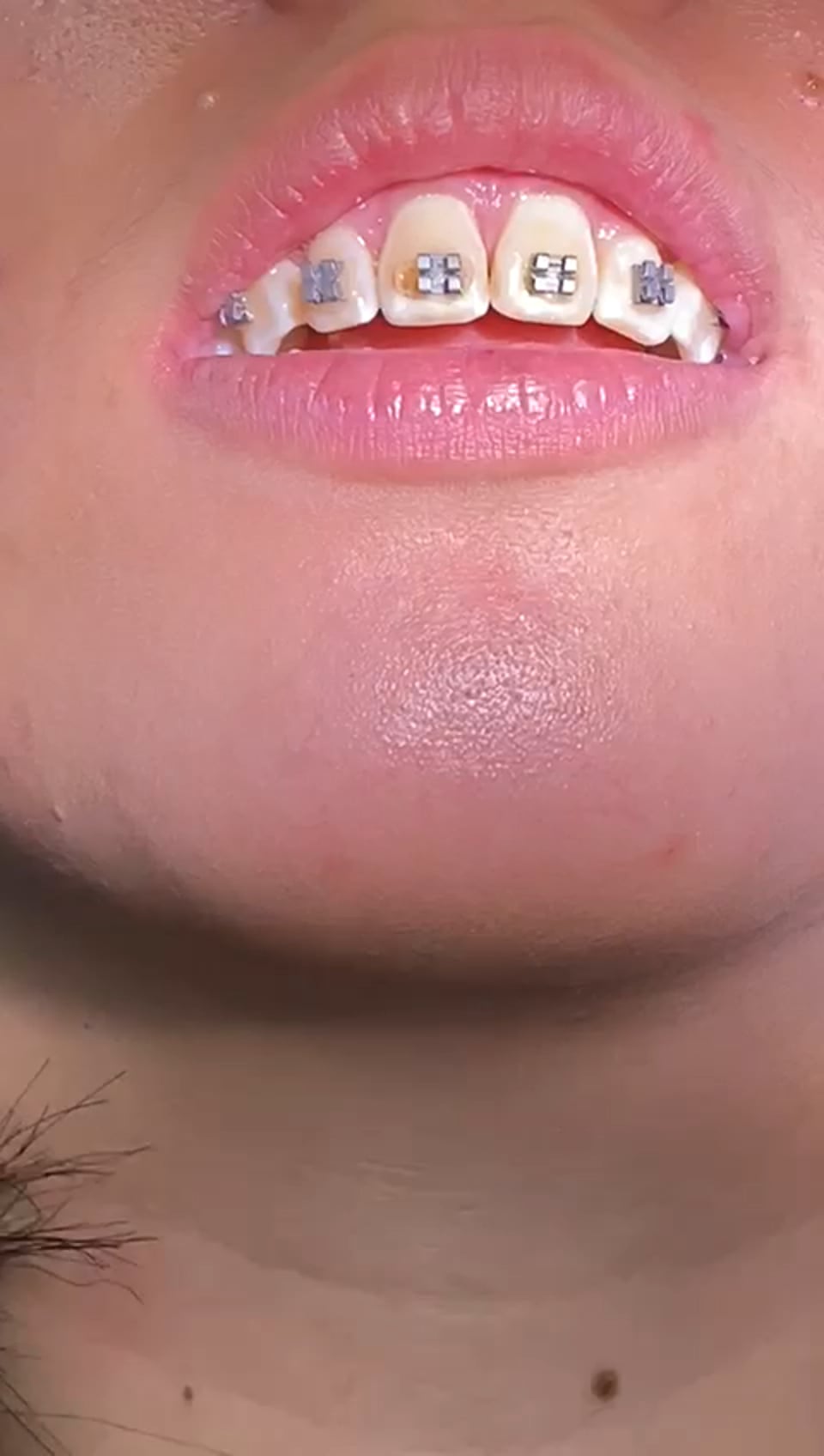 Archwire Insertion