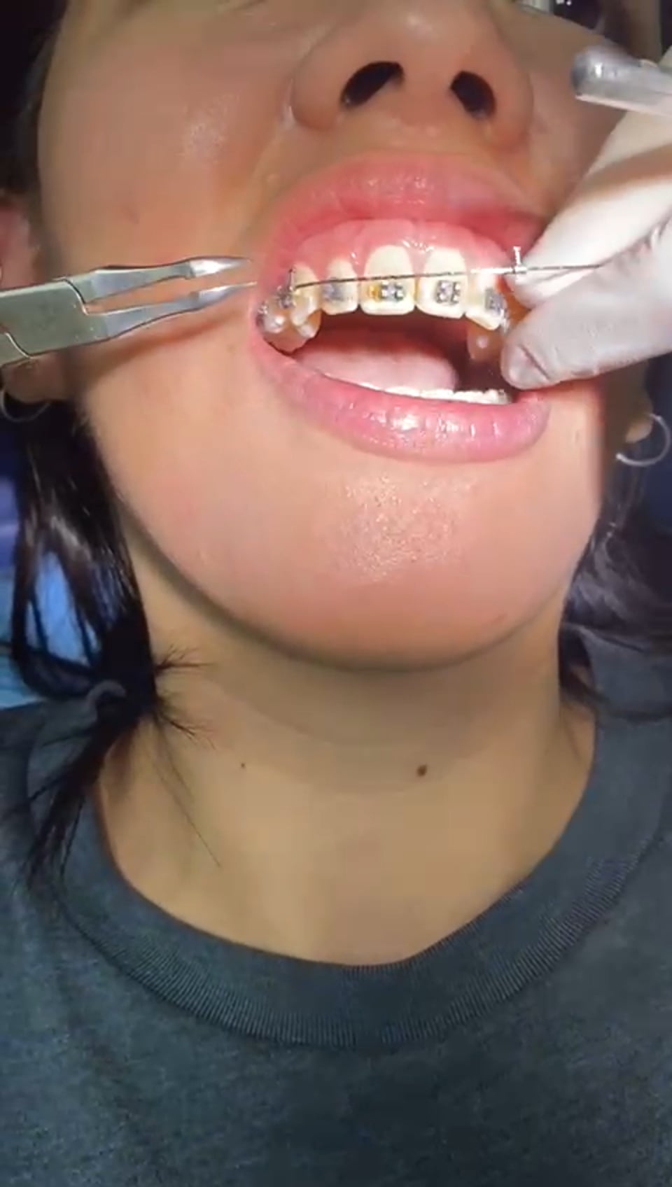 Archwire Removal