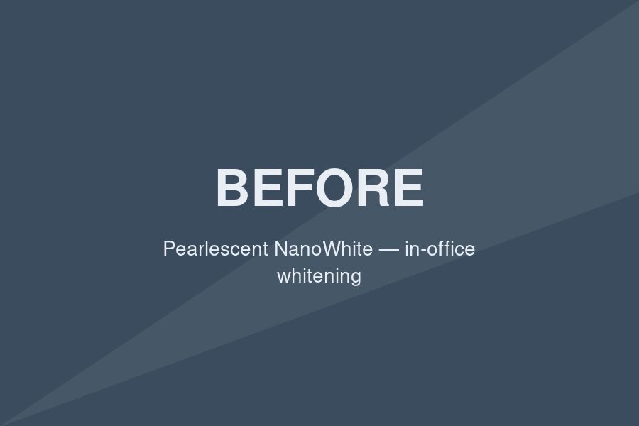 Before — Predictable shade improvement with Pearlescent NanoWhite