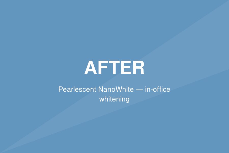 After — Predictable shade improvement with Pearlescent NanoWhite