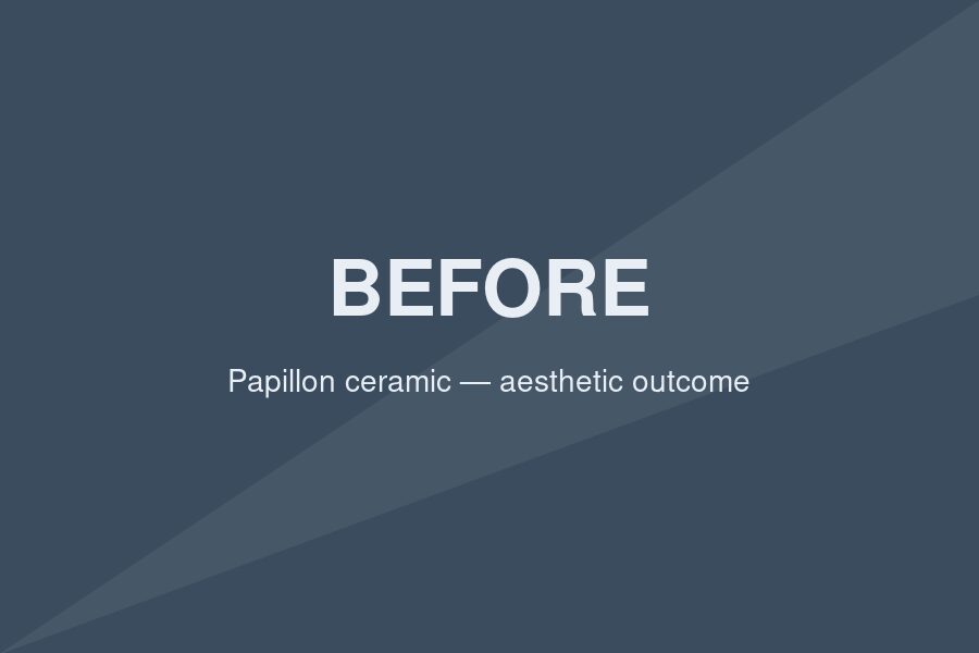 Before — Aesthetic outcomes adult patients ask for — Papillon ceramic